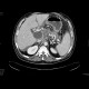 Mutliple pseudocysts of the pancreas following acute pancreatitis: CT - Computed tomography